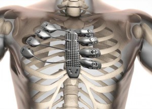 la potrine de l'homme avec un implant technologique incrusté